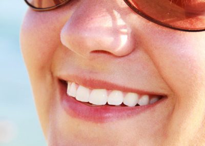 Branqueamento Dentário