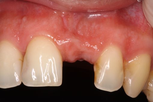 Implantes Dentários — Clínica Dentária do Porto (2)