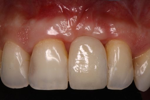 Implantes Dentários — Clínica Dentária do Porto (5)