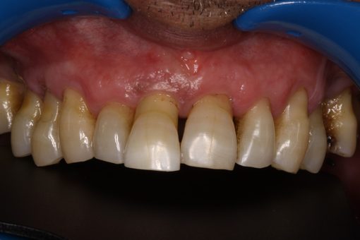 Implantes Dentários — Clínica Dentária do Porto (3)