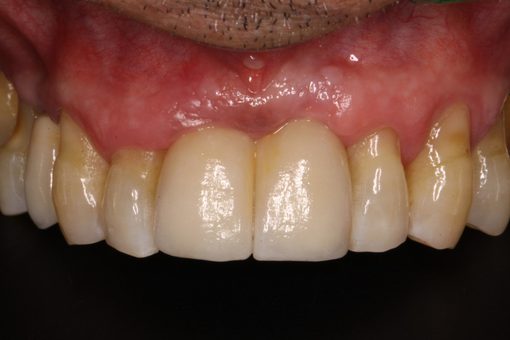 Implantes Dentários — Clínica Dentária do Porto (6)