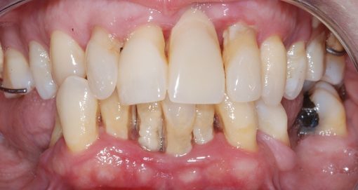 Implantes Dentários — Clínica Dentária do Porto (4)
