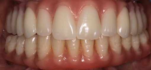 Implantes Dentários — Clínica Dentária do Porto (7)
